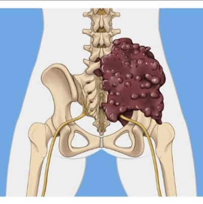 How Pelvic Tumors Cause Sciatica: Preventive Strategies & Effective Treatment Supplements
