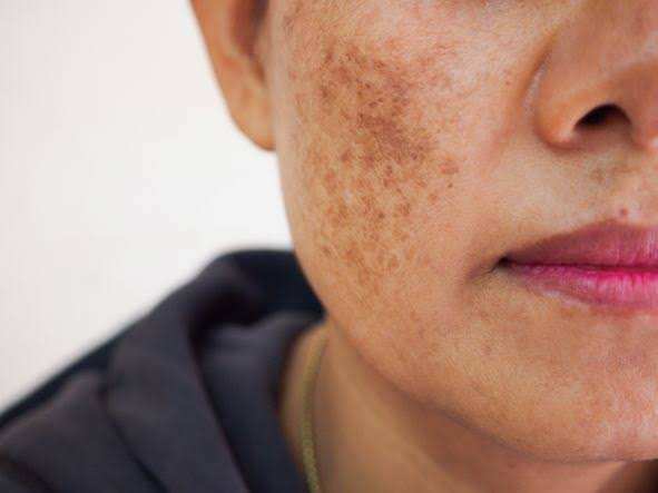 Natural Supplements That Treats Hyperpigmentation Without Using Harsh Chemicals