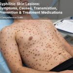 Syphilitic Skin Lesions: Symptoms, Causes, Transmission, Prevention & Treatment Medications