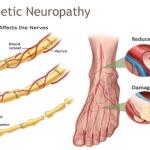 Causes of Diabetic Neuropathy: Preventive Strategies & Effective Treatment Supplements