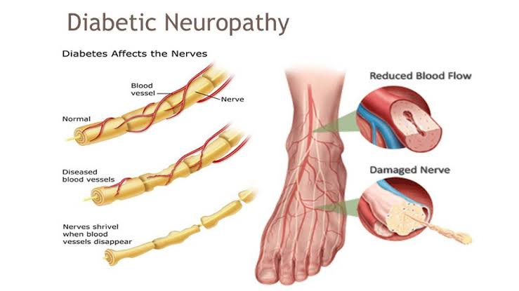 Causes of Diabetic Neuropathy: Preventive Strategies & Effective Treatment Supplements