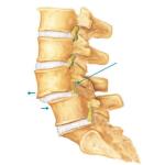 How Spondylolisthesis Causes Sciatica: Preventive Strategies & Effective Treatment Supplements for Lasting Relief