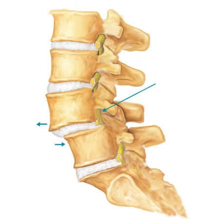How Spondylolisthesis Causes Sciatica: Preventive Strategies & Effective Treatment Supplements for Lasting Relief