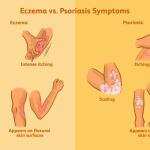 Differences Between Psoriasis & Eczema and How to Treat Them