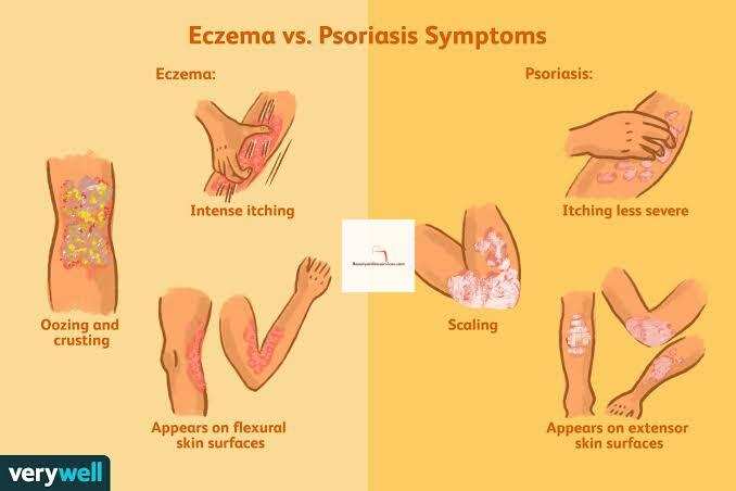 Differences Between Psoriasis & Eczema and How to Treat Them