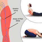 Effective Stretches and Postures for Sciatica Relief & Prevention