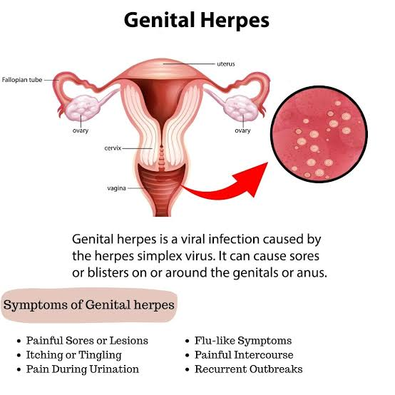 Genital Herpes: Causes, Transmission, Prevention & Medications