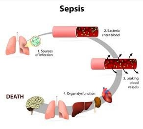 Sepsis: Symptoms, Causes, Risks, Prevention & Medications