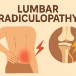 Lower Back Nerve Pain (Lumbar Radiculopathy) Causes: Preventive Strategies & Effective Treatment Supplements