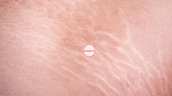 Understanding Stretch Marks: How Do They Happen, Symptoms, Causes, Prevention & Treatment Herbal Remedies