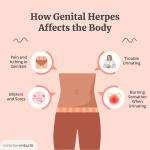 Genital Herpes Treatment Medicine in Ghana