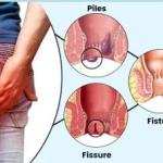 Piles or Kooko Treatment Medicine in Ghana